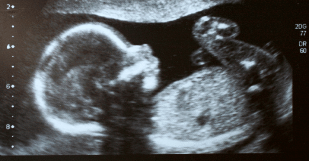 Successful Fertility outcomes, baby, zygote